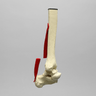 Ankle Joint with Ruptured Achilles