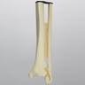 Ankle with Displaced Oblique Fracture