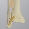 Ankle with Displaced Oblique Fracture