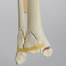 Ankle with Medial Malleolar and Oblique Fractures