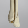Ankle with Medial Malleolar and Oblique Fractures