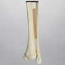 Ankle with Medial Malleolar and Oblique Fractures