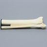 Ankle with Lateral Malleolar Fracture