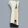 Ankle with Lateral Malleolar Fracture