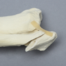 Ankle with Lateral Malleolar Fracture