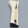 Ankle with Lateral Malleolar Fracture