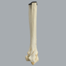 Ankle with Pilon and Oblique Fractures
