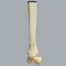 Ankle with Pilon and Oblique Fractures