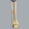 Ankle with Pilon and Oblique Fractures