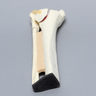 Ankle with Malleolar Fractures