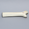 Ankle with Malleolar Fractures