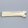 Ankle with Malleolar and Spiral Fractures