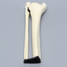 Ankle with Malleolar and Spiral Fractures