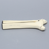 Ankle with Malleolar and Spiral Fractures