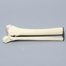 Ankle with Malleolar and Spiral Fractures