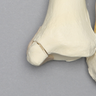 Ankle with Medial and Posterior Malleolar, and Oblique Fibular Fractures