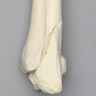 Ankle with Medial and Posterior Malleolar, and Oblique Fibular Fractures