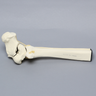 Ankle with Supination-Adduction Fracture