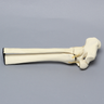 Ankle with Supination-Adduction Fracture