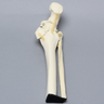 Ankle with Supination-Adduction Fracture