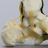 Foot and Ankle with Three-Part Calcaneal Fracture
