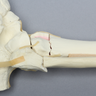Foot and Ankle with Tibial Three-Part Pilon and Fibular Oblique Fractures