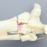 Foot and Ankle with Tibial Three-Part Pilon and Fibular Oblique Fractures
