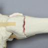 Foot and Ankle with Tibial Three-Part Pilon and Fibular Oblique Fractures