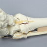 Foot and Ankle with Tibial Three-Part Pilon and Fibular Oblique Fractures