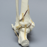 Foot and Ankle with Pilon Fracture
