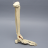 Foot and Ankle with Articulation and Tibial Pilon and Transverse Fibular Fractures