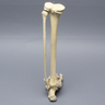Foot and Ankle with Articulation and Tibial Pilon and Transverse Fibular Fractures