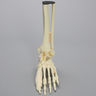 Foot and Ankle with Fractures and Articulation at IP Joint
