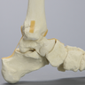 Foot and Ankle with Fractures and Articulation at IP Joint