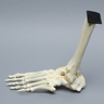 Foot and Ankle with Arthritis and Calcaneal Malunion
