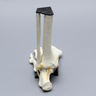 Foot and Ankle with Five-Part Talar Fracture, Bunions, and Hammertoes