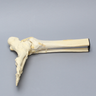 Foot and Ankle with Tibial Pilon and Fibular Oblique Fractures and Talar Rotation