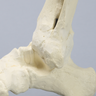Foot and Ankle with Fusion, Abduction, and Equinus Deformities