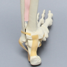 Foot and Ankle with Multiple Deformities, 18 Degree Varus and 10 Degree Recurvatum