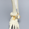 Foot and Ankle with Multiple Deformities, 18 Degree Varus and 10 Degree Recurvatum