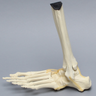 Foot and Ankle with Lisfranc Fracture