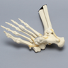 Foot and Ankle with Lisfranc Fracture