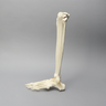 Foot and Ankle with Malunion and Valgus Deformity