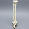 Foot and Ankle with Tibial Four-Part Pilon and Fibular Oblique Fractures