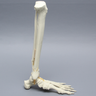 Foot and Ankle with Tibial Four-Part Pilon and Fibular Oblique Fractures