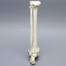 Foot and Ankle with Tibial Four-Part Pilon and Fibular Oblique Fractures