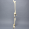 Full Leg with Femoral "Y" and Tibial Oblique Fractures