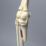 Full Leg with Femoral "Y" and Tibial Oblique Fractures
