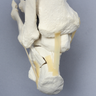 Foot and Ankle with Wall and Neck Fractures of Calcaneus and Talus