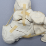 Foot and Ankle with Wall and Neck Fractures of Calcaneus and Talus